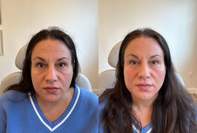 Dermal Fillers Before & After Image