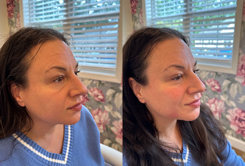 Dermal Fillers Before & After Image