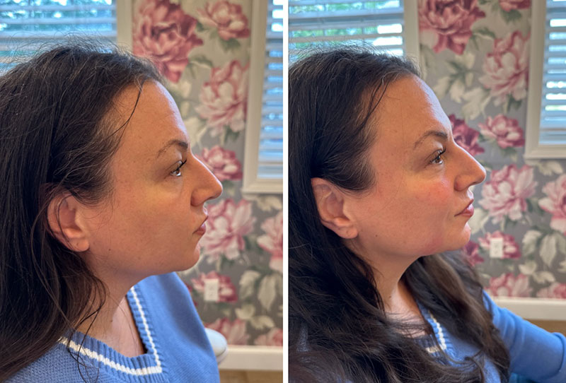 Dermal Fillers Before & After Image