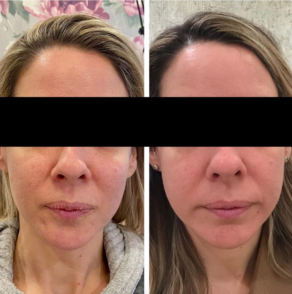 CoolPeel Before & After Image