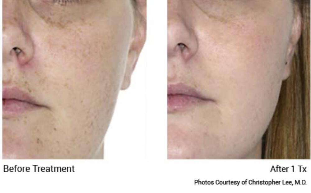 IPL Facial Before & After Image