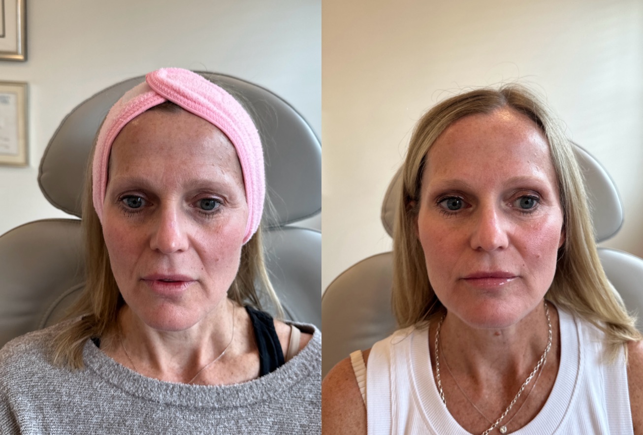 Thread Lift Before & After Image