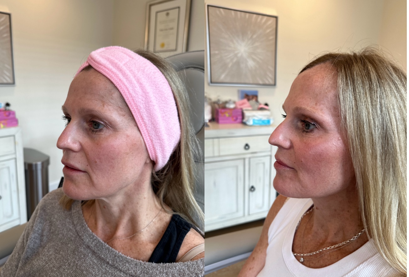 Thread Lift Before & After Image