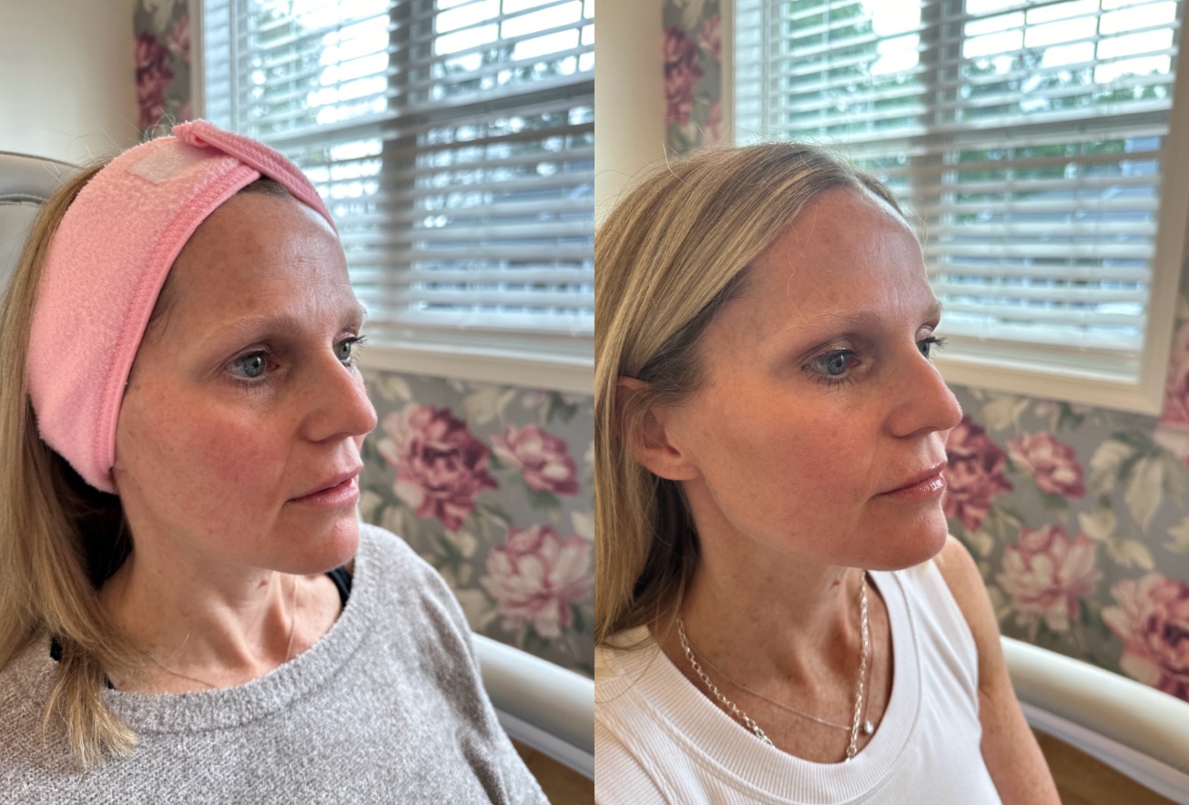 Thread Lift Before & After Image