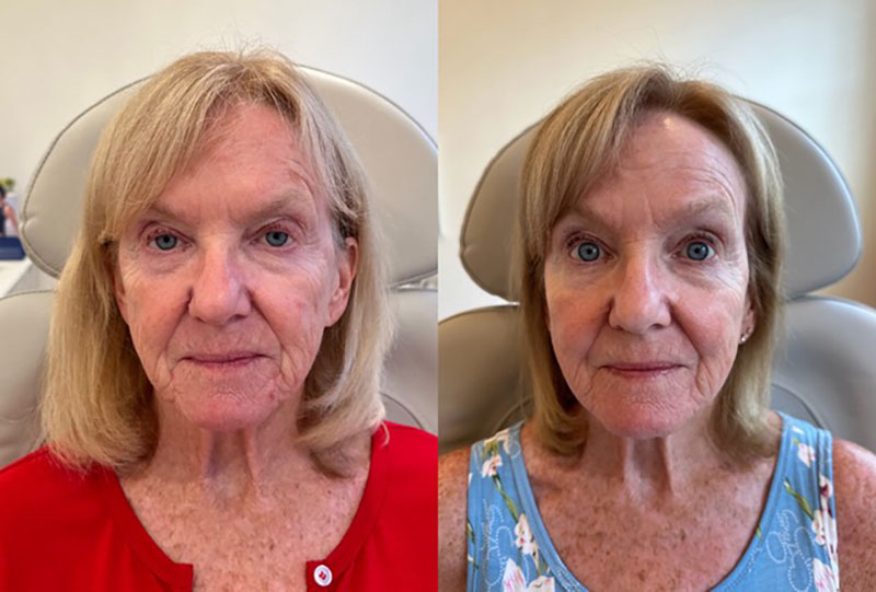 Thread Lift Before & After Image