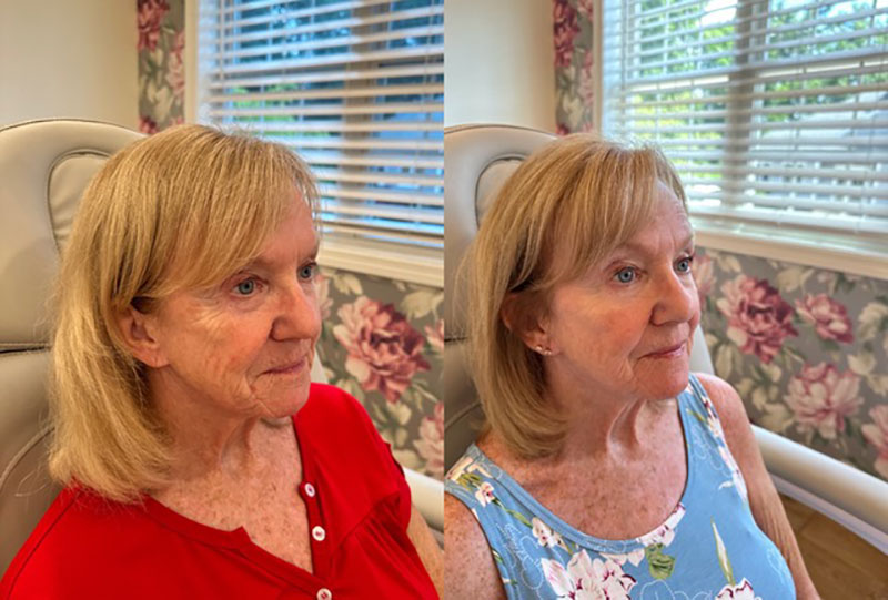 Thread Lift Before & After Image